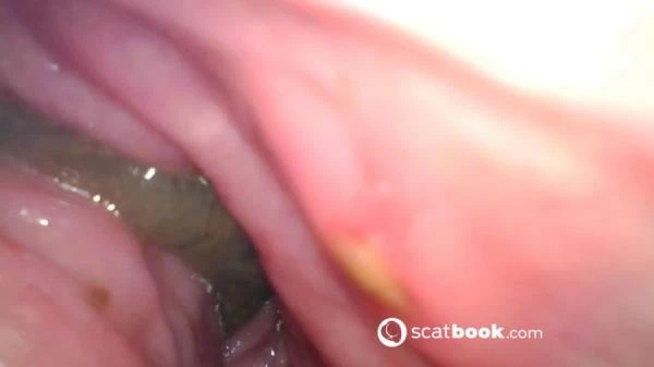 Endoscope In My Ass (Scat) [FullHD 1080p / 647 MB]